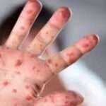 குரங்கு அம்மை பரவல் அவசர நிலை அறிவித்தது உலக சுகாதார அமைப்பு